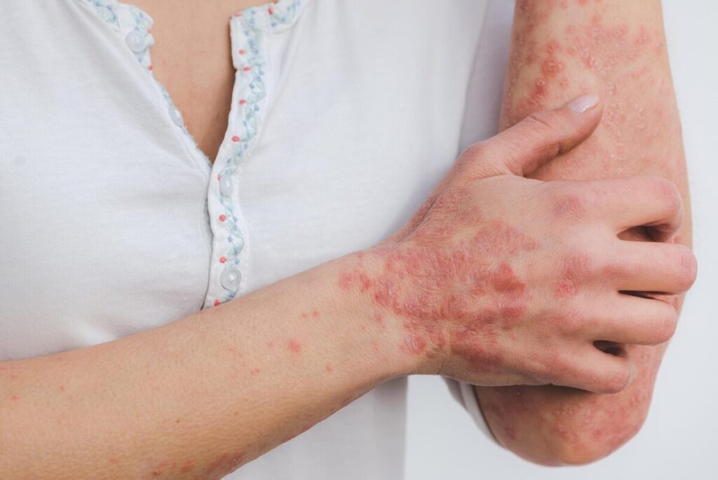 Psoriasis : tout comprendre sur cette maladie inflammatoire chronique de la peau