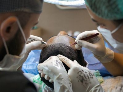 Dermopigmentation_capillaire_:_une_solution_efficace_pour_les_problèmes_de_calvitie_et_de_perte_de_cheveux