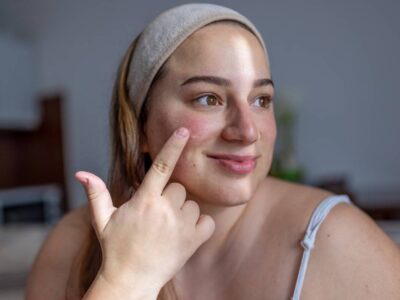 Les solutions naturelles pour mieux vivre avec le psoriasis au quotidien