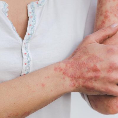 Psoriasis : tout comprendre sur cette maladie inflammatoire chronique de la peau